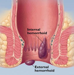 Heal Anal Tear 61